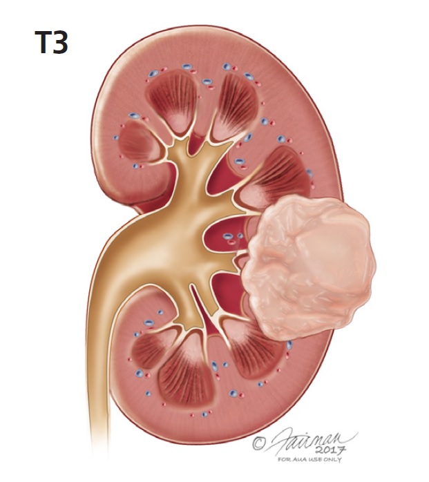 Urology Care Foundation What Is Kidney Cancer   KCC 3 